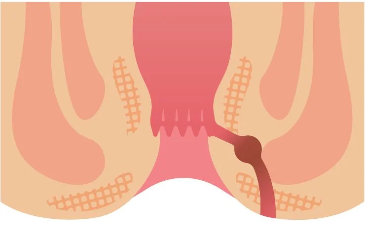 Fistula